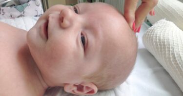 Slika od Mama dijeli znak koji je uočila na bebinoj glavi, a koji je bio simptom meningitisa
