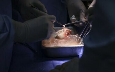 Slika od Po prvi put čovjeku transplantiran bubreg genetski modificirane svinje