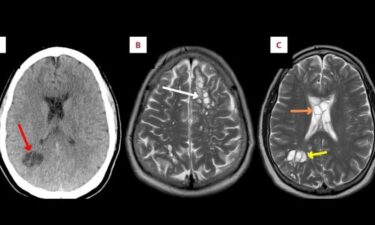 Slika od Čovjek pogrešno pripremao slaninu pa dobio trakavicu u mozgu: Počelo je migrenom