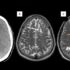 Slika od Čovjek pogrešno pripremao slaninu pa dobio trakavicu u mozgu: Počelo je migrenom