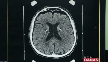 Slika od Liječnici u Zagrebu ugradili čovjeku stimulator mozga. “Može voziti bicikl, plivati”