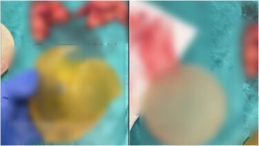 Slika od Plastični kirurg iz Hrvatske pokazao što je pronašao u prsima jedne žene. Prizor je vrlo jeziv