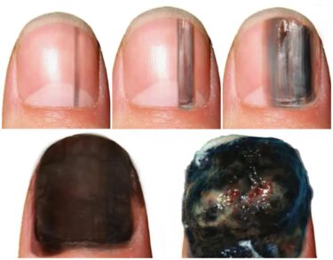 Slika od Zastrašujući ubrzani video pokazuje kako se ‘mrljica‘ na noktu može pretvoriti u smrtonosni rak 4. stupnja – pogledajte!