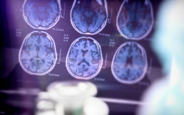 Slika od Revolucionarna, nova metoda skeniranja mozga predviđa ovu opaku bolest i do devet godina ranije
