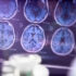 Slika od Revolucionarna, nova metoda skeniranja mozga predviđa ovu opaku bolest i do devet godina ranije