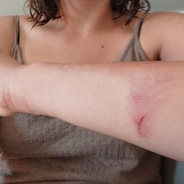 Slika od Nagrađivanu novinarku napali otac i sestra poznatog zadarskog HDZ-ovca! ‘Čupala me za kosu! Ugrizla sam je do krvi!‘