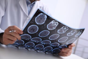 Slika od Umjetna inteligencija mogla bi donijeti revolucionarni napredak kod oboljelih od Alzheimera