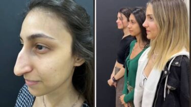 Slika od VIDEO Tri sestre otišle su na operacije nosa, rezultati sve šokirali: ‘Pa to nisu iste osobe!’